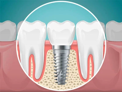 Noua acoperire a implantului protejează împotriva infecțiilor bacteriene